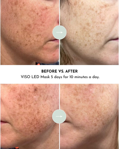 VISO FDA-Certified Red Light Therapy Mask